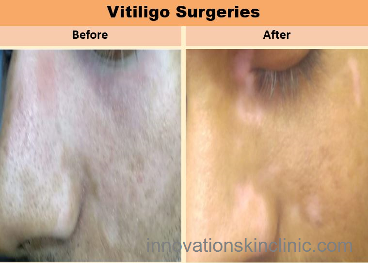 Vitiligo Surgery 1